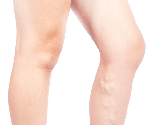 female legs with varicose veins on white background picture id1183539692