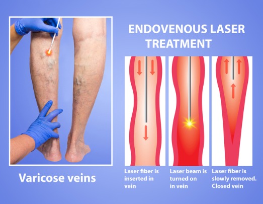 varicose veins and laser picture id885968448