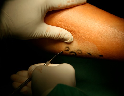 varicose veins repair picture id145991634