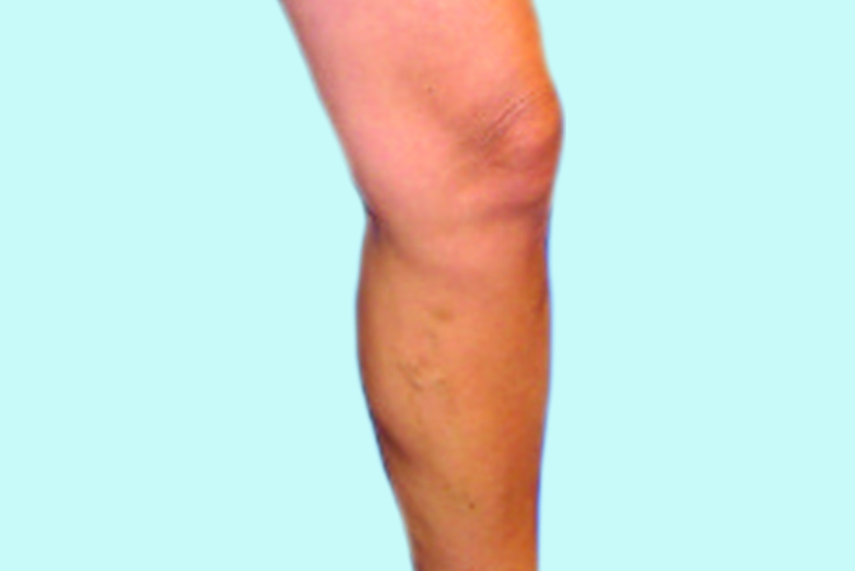 Laser Endovenous Ablation