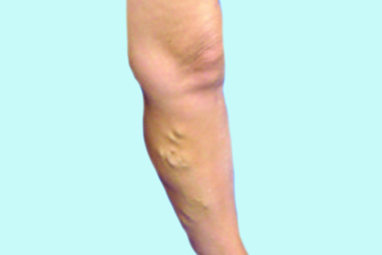Laser Endovenous Ablation